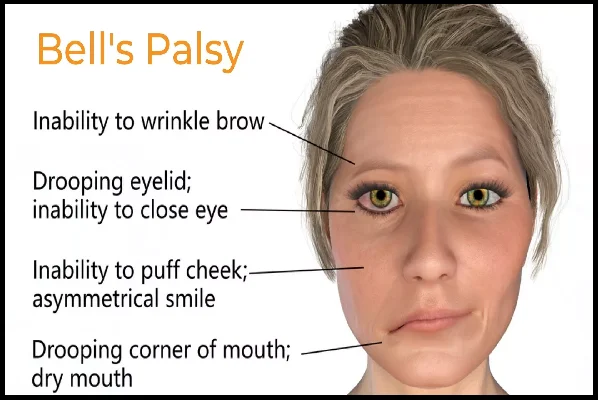 Bells Palsy
